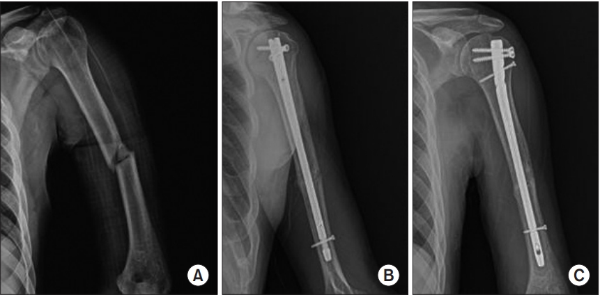 Treatment of Humeral Shaft Fracture with Retrograde Intramedullary Nail